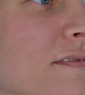 Лазерная шлифовка рубца  - фото після