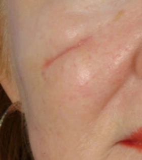 Лазерная шлифовка рубца  - фото до