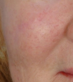 Лазерная шлифовка рубца  - фото після