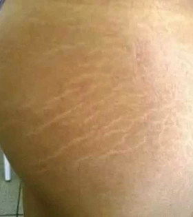 Лазерне шліфування розтяжок в Одесі. - фото до