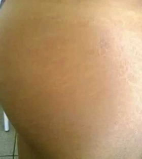 Лазерне шліфування розтяжок в Одесі. - фото після