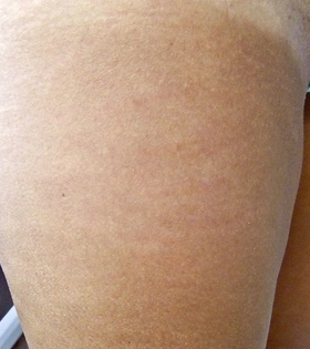 Лазерне шліфування розтяжок в Одесі. - фото після