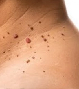 Лазерное удаление папиллом - фото до