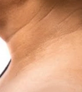 Лазерное удаление папиллом - фото після