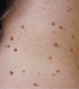 Лазерное удаление папилломавирусы - фото до