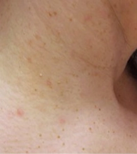 Лазерное удаление папилломавирусы - фото після