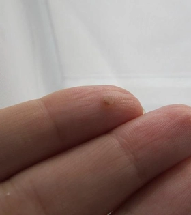 Лазерное удаление бородавок - фото до