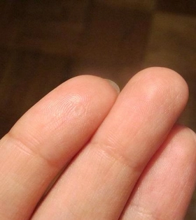 Лазерное удаление бородавок - фото після