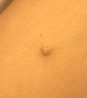 Лазерное удаление бородавки - фото до