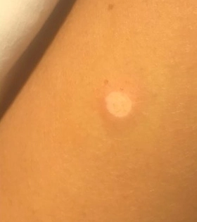 Лазерное удаление бородавки - фото після