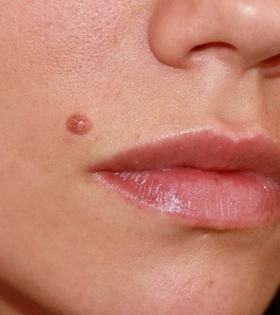 Лазерное удаление родинок - фото до