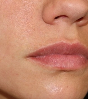 Лазерное удаление родинок - фото після