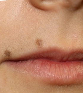 Лазерное удаление родинок - фото до