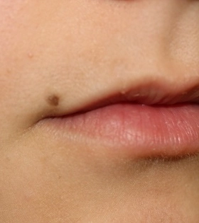 Лазерное удаление родинок - фото після