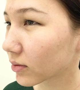 Кантопластика_3 - фото до