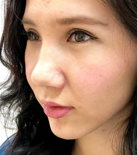 Кантопластика_3 - фото після