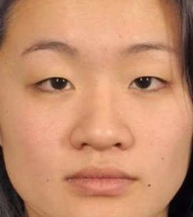 Кантопластика_4 - фото до