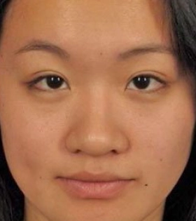 Кантопластика_4 - фото після