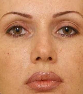 Кантопластика_1 - фото до