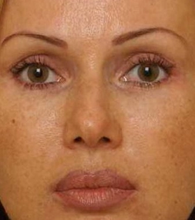 Кантопластика_1 - фото після