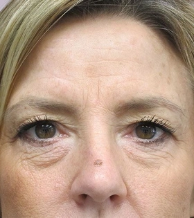Блефаропластика - фото до