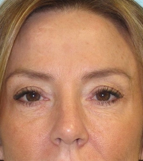 Блефаропластика - фото після