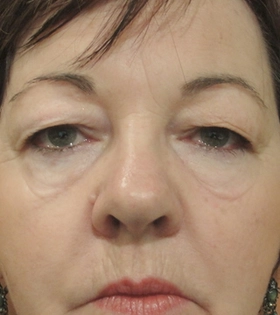 Блефаропластика в Києві - фото до