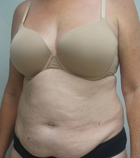 Абдоминопластика - фото до