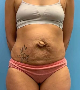 Абдоминопластика - фото до