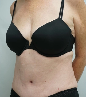Абдоминопластика - фото після
