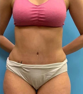Абдоминопластика - фото після