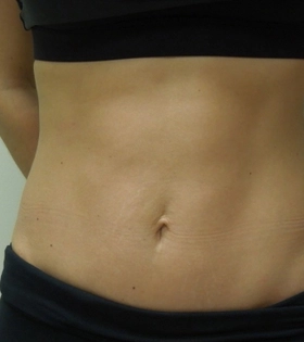 Миниабдоминопластика - фото після
