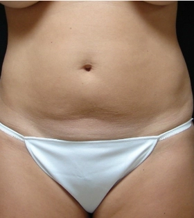 Миниабдоминопластика - фото до