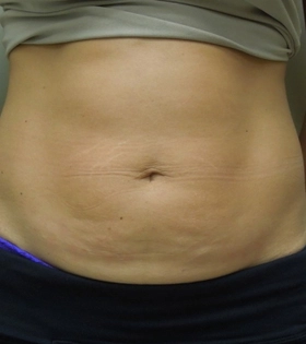 Миниабдоминопластика - фото до