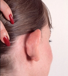 Отопластика - фото до