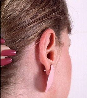 Отопластика - фото після