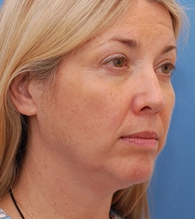 Круговая подтяжка лица - фото до