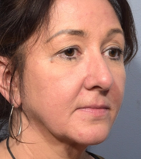 Круговая подтяжка лица - фото після