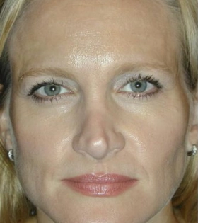 Хирургическая подтяжка бровей - фото до