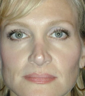 Хирургическая подтяжка бровей - фото після