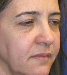 Хирургическая подтяжка бровей - фото до