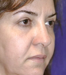 Хирургическая подтяжка бровей - фото після