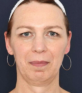 Хирургическая подтяжка лба - фото до