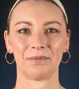 Хирургическая подтяжка лба - фото після