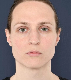 Хирургическая подтяжка лба - фото до