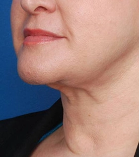 Хирургическая подтяжка шеи - фото до