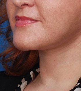 Хирургическая подтяжка шеи - фото після