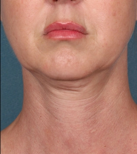 Хирургическая подтяжка шеи - фото до