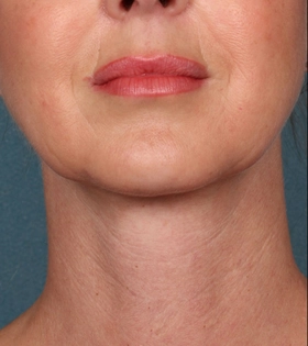 Хирургическая подтяжка шеи - фото після