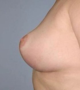 Уменьшение груди - фото після